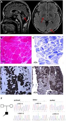 Case Report: Stress-Induced Childhood-Onset Neurodegeneration With Ataxia-Seizures Syndrome Caused by a Novel Compound Heterozygous Mutation in ADPRHL2
